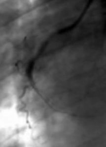 Később, a beavatkozás során egyszer-kétszer a bal alsó képernyőrészt láthattam. Ott feltűnt a szívemben lévő megfestett erek képe. A többi részét a képernyőnek eltakarták más készülékek, de egy pillanatra láttam azért a vérnyomásom, a pulzusom, s a szaturáció mérési eredményeit.