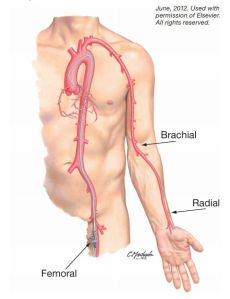 A stent beültetés lényege, hogy vagy a csukló artérián, vagy a comb artérián (esetleg valamely más nagy éren) keresztül bevezetnek egy katétert a szívbe, valójában abba az érbe, ahol a gond van. Ennek a segítségével a beszűkült eret megnyitják, kitágítják - az én esetemben viccesen úgy neveztem, el, hogy a plakkot “kitakarítják”, majd egy stentet (magyarul belső ér protézisnek hallottam emlegetni) helyeznek el az érben, megoldandó a vér folyamatos, megfelelő áramlását, illetve így kisérlik meg megakadályozni az újabb beszűkülést.