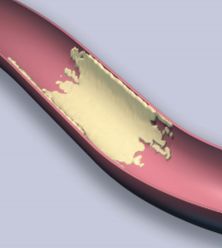 A betegség kialakulása során ugyanis az előzmények lehetnek akár szinte tünetmentesek, vagy csupán kevés tünettel járhatnak, például, ami nálam is kialakult, volt nehéz légzésem, indokolatlanul fáradtnak éreztem magam, heves szívdobogásom volt, nagyon erős ütéseket éreztem. Ami komoly tünetem volt, az az állandó fibrilláció. Az oxigénellátás zavara szívritmuszavart, szívelégtelenséget és angina pectoris nevű betegséget okoz. A következmény lehet szívizom elhalással járó szívinfarktus, illetve szívleállás, azaz halál.
