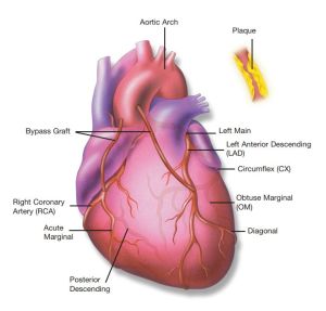 Ezt az állapotot a népnyelv érelmeszesedésnek nevezi. Szaknyelven ez az arterioszklerózis, aminek a lényege, hogy az érfalakon plakkok keletkeznek, amelyek fokozatosan “növekszenek”, s akár teljesen el is zárhatják az eret. Nálam ez történt. Az erek fala ilyenkor elveszti a rugalmasságát, az ér keresztmetszete olyan szűk lesz, hogy a véráramlás lelassul, akár le is állhat.